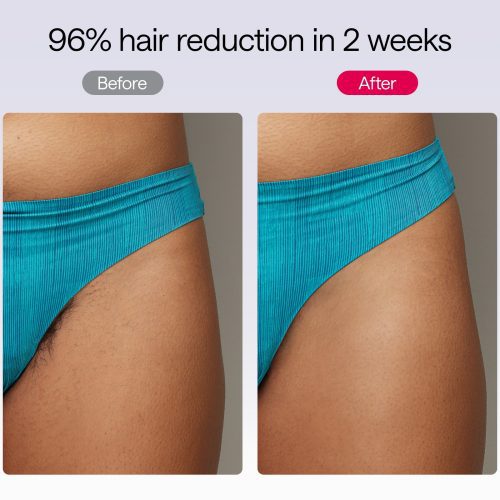 Air 10 hair removal before and after results