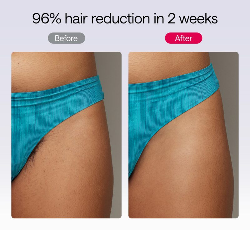 Air 10 hair removal before and after results